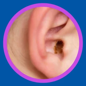 An ear with visible ear wax. 